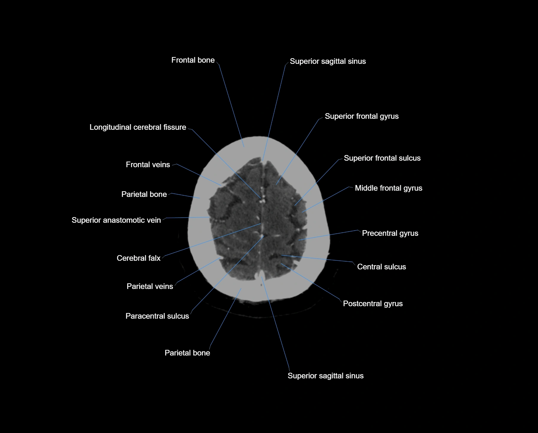 CT scan brain axial labelled cross sectional anatomy image-img-000065.webp